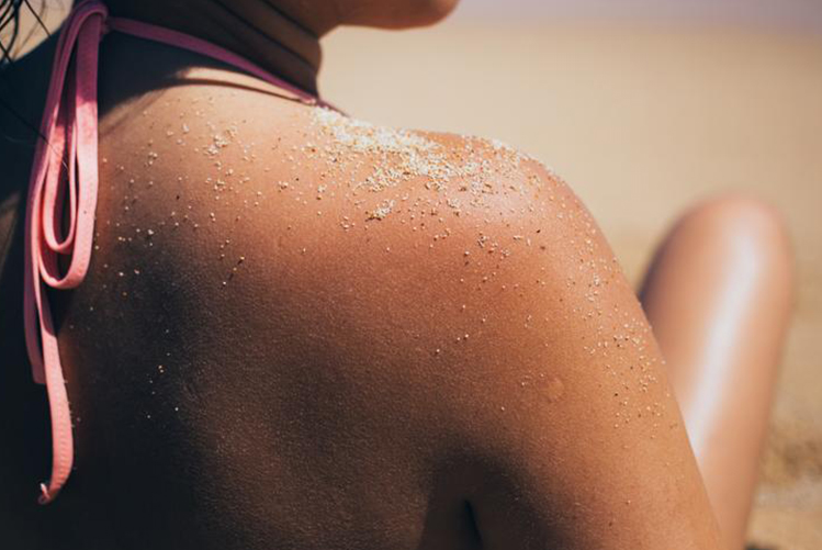 Coup de soleil : les soigner au naturel