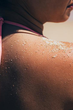 Coup de soleil : les soigner au naturel